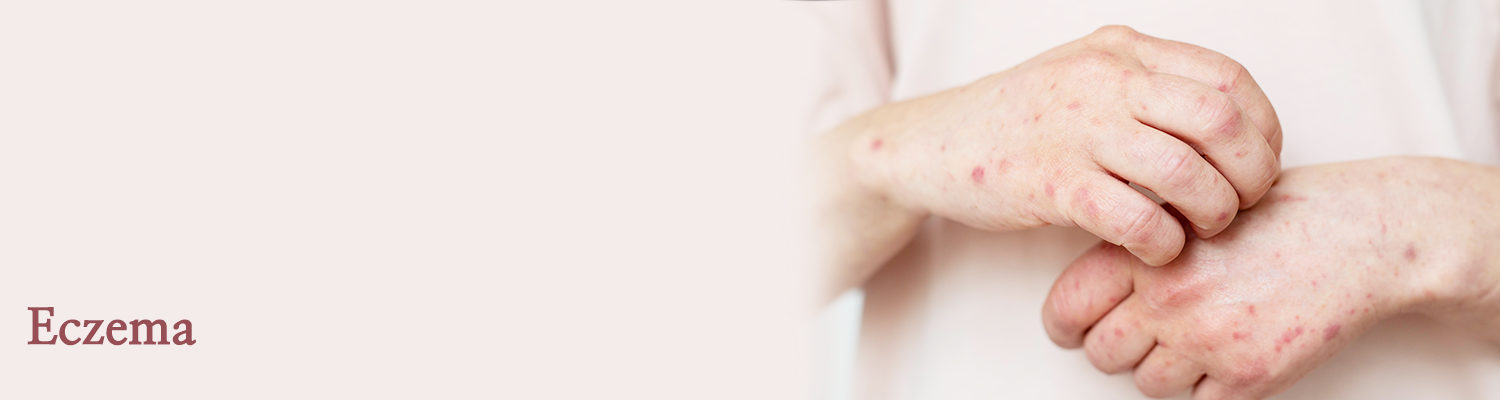 Eczema Image