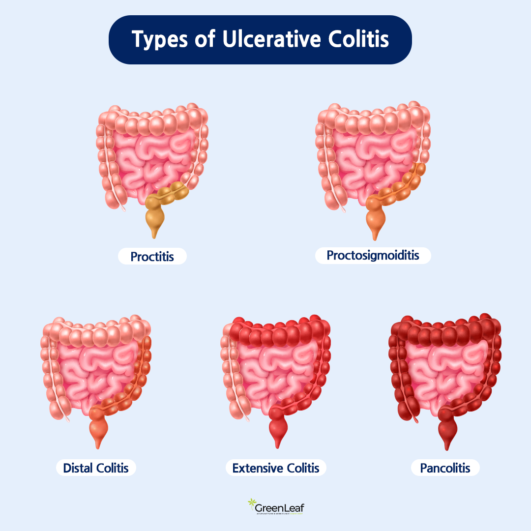 Types of Ulcerative Colitis