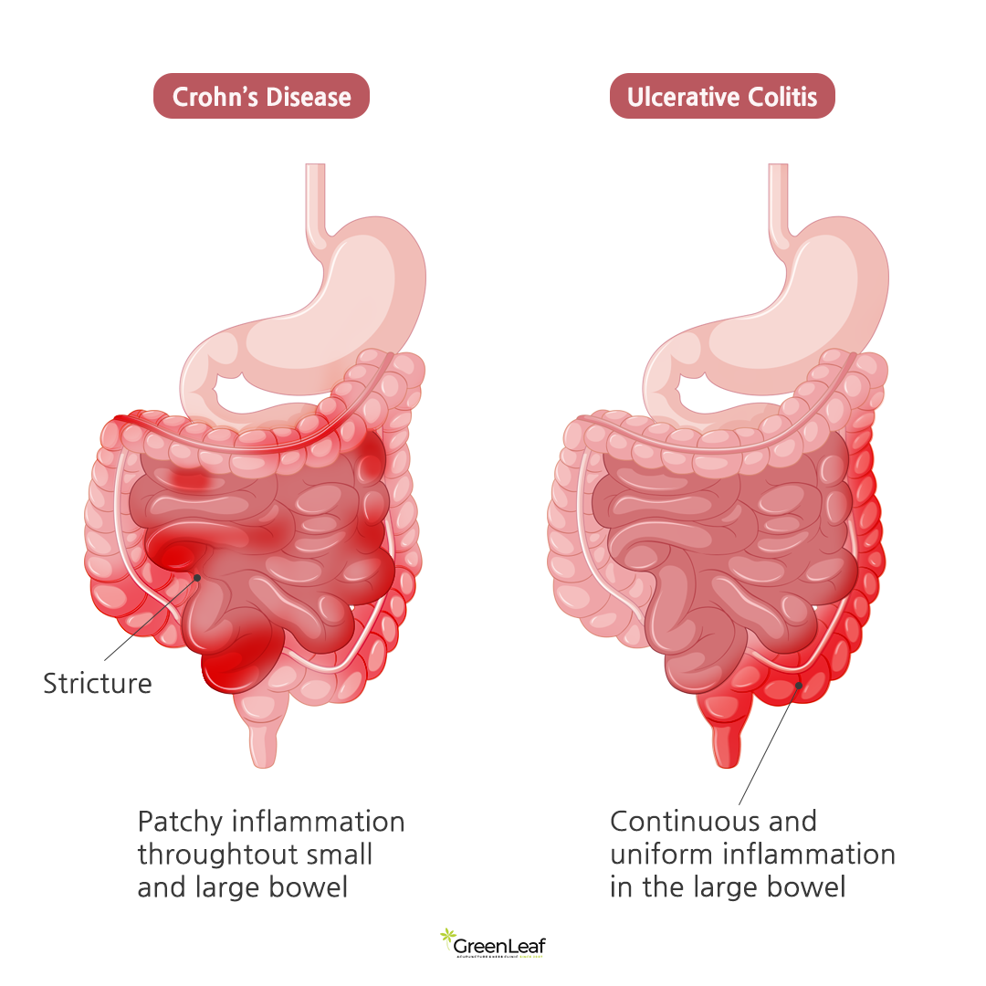 Ulcerative Colitis vs Crohn’s Disease - Image