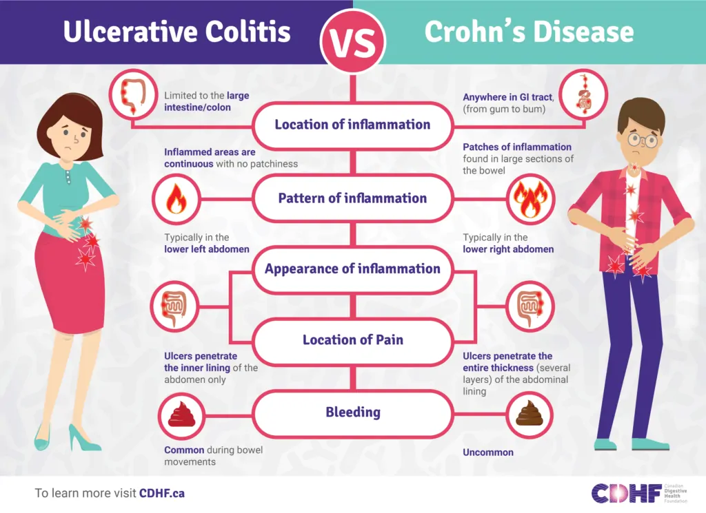 Ulcerative Colitis vs Crohn’s Disease - Image