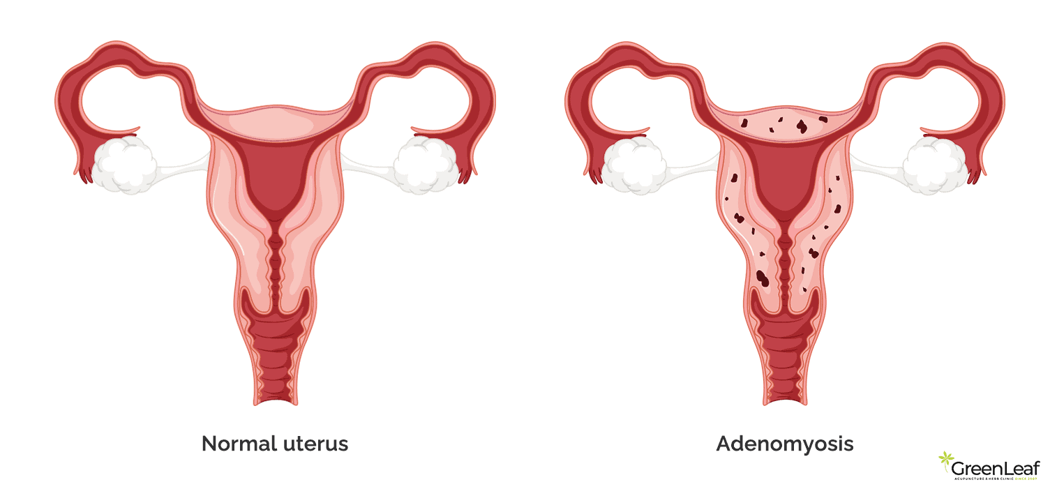 Normal Adenomyosis Image