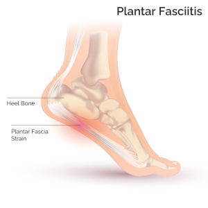 Plantar Fasciitis, Foot